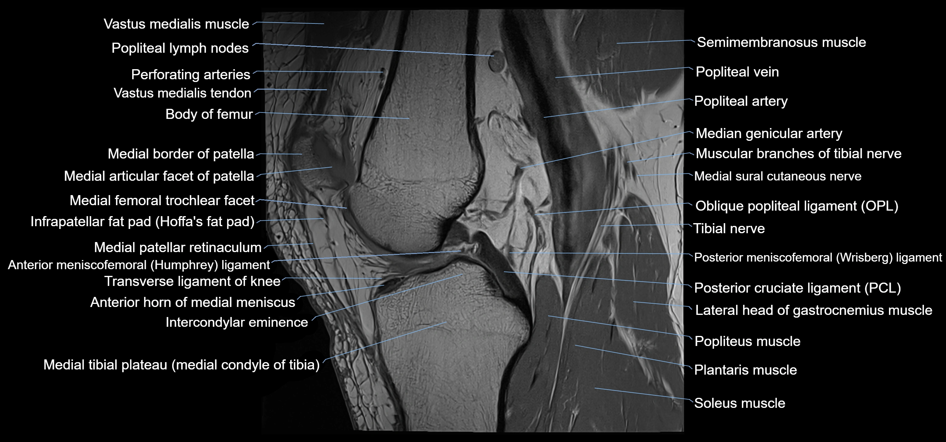 MRI knee sagittal cross sectional anatomy labelled 3T radiology image-00024.webp